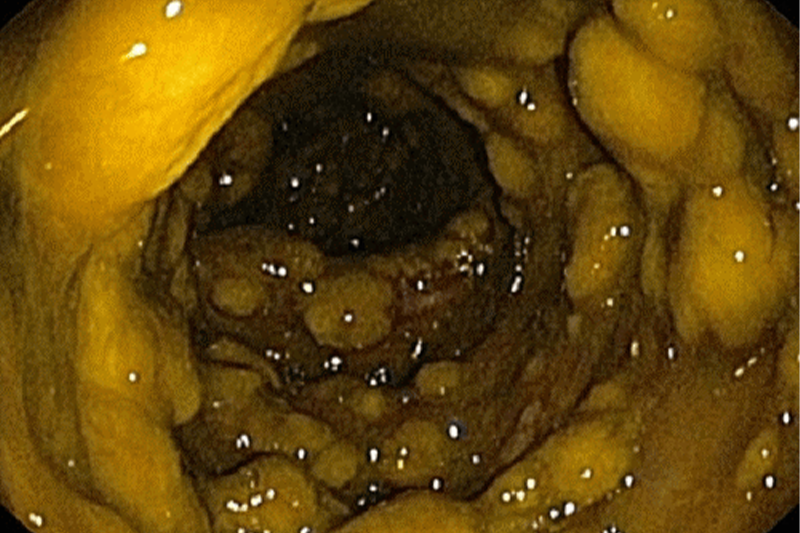  Hỉnh ảnh nội soi viêm đại tràng do Clostridioides difficile