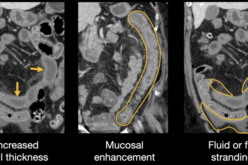 Hình ảnh CT viêm đại tràng
