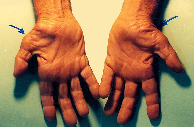 Làm thế nào để chẩn đoán hội chứng đường hầm cổ tay?
