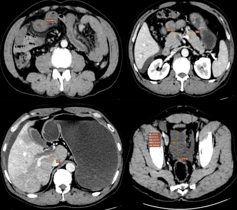 Hình ảnh chụp cắt lớp vi tính có tiêm thuốc cản quang của bệnh nhân 