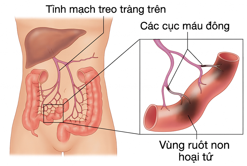 Cục máu đông làm tắc tĩnh mạch gây ra tình trạng hoại tử ruột non. Ảnh minh họa 