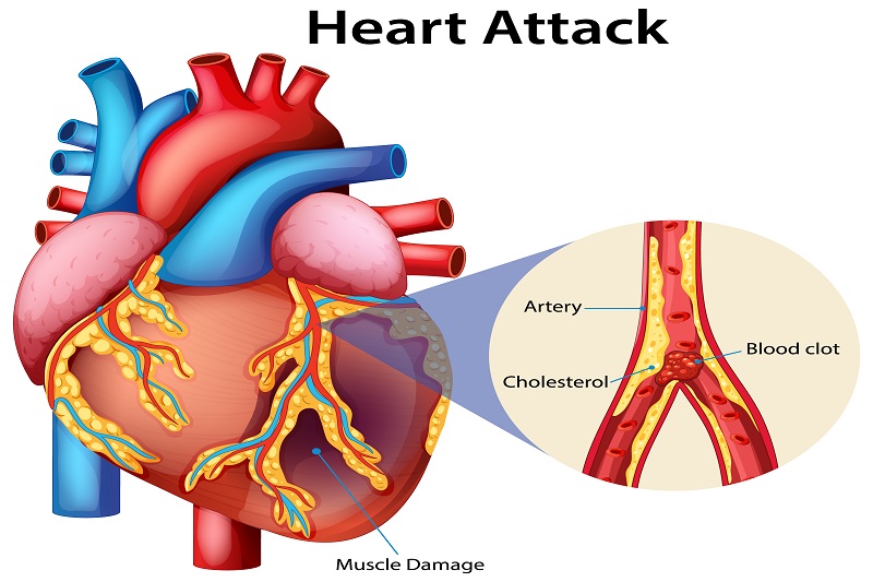 Mảng xơ vữa động mạch tồn tại lâu ngày hình thành cục máu đông gây nhồi máu cơ tim