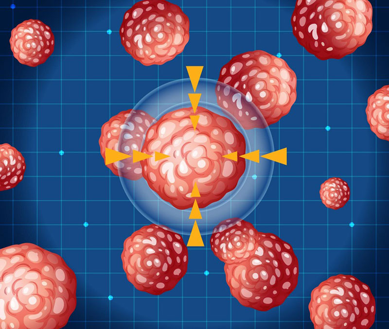 Chi phí loại bỏ u mỡ phụ thuộc khá lớn vào kích thước khối u