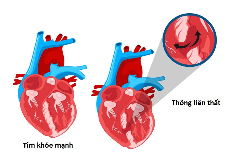 Hình ảnh mô phỏng vị trí lỗ thông trong bệnh thông liên thất