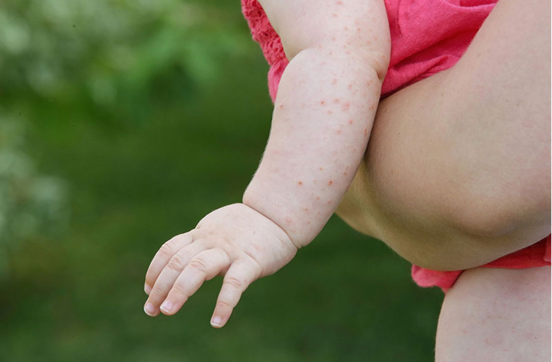 Triệu chứng và dấu hiệu đặc biệt của bé sốt nổi mẩn đỏ khắp người là gì?
