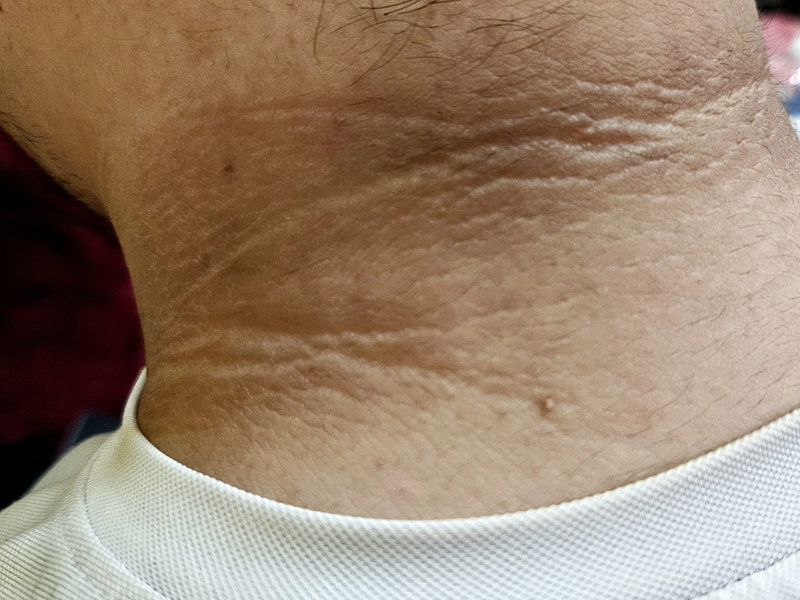 Xuất hiện gai đen vùng cổ gáy là dấu hiệu cảnh báo bệnh lý tiểu đường type 2. Ảnh minh họa