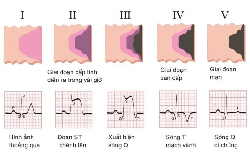 Hình ảnh mô phỏng kết quả ECG nhồi máu cơ tim