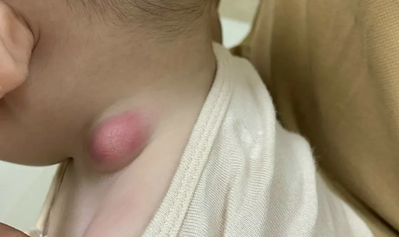 Tình trạng nhiễm trùng có thể là nguyên nhân khiến trẻ em bị nổi hạch ở cổ