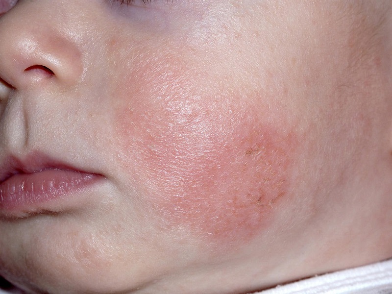 Dấu hiệu và cách chữa trị bệnh chàm da ở trẻ em một cách tự nhiên