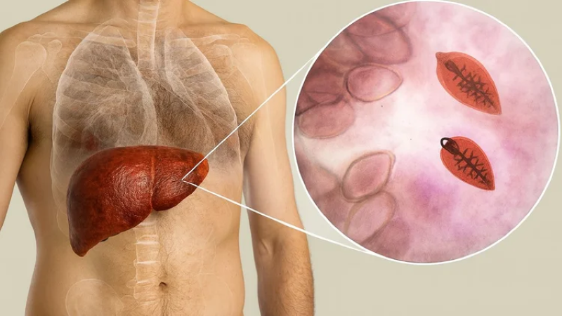 Bệnh sán lá gan thường tiến triển qua hai giai đoạn