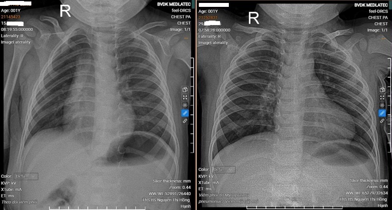 Kết quả chụp X-quang phổi của bệnh nhân trước và sau khi điều trị