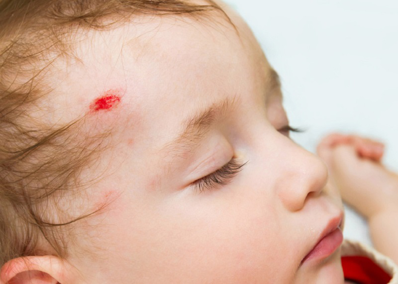 Tuyệt đối không được bôi dầu gió lên vết thương sau khi trẻ bị ngã đập đầu phía trước