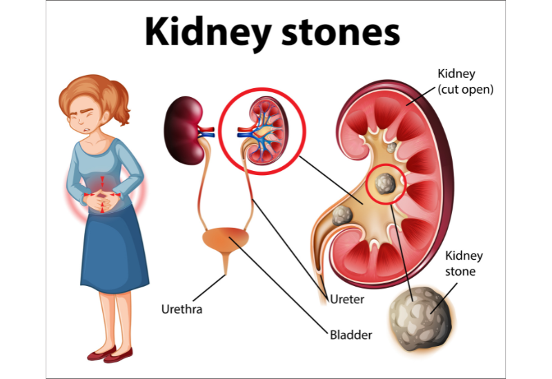 Sỏi thận là tình trạng các tinh thể muối khoáng kết tinh và lắng đọng trong thận