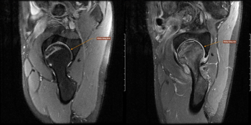 Hình ảnh hoại tử vô khuẩn chỏm xương đùi hai bên, ưu thế bên trái 