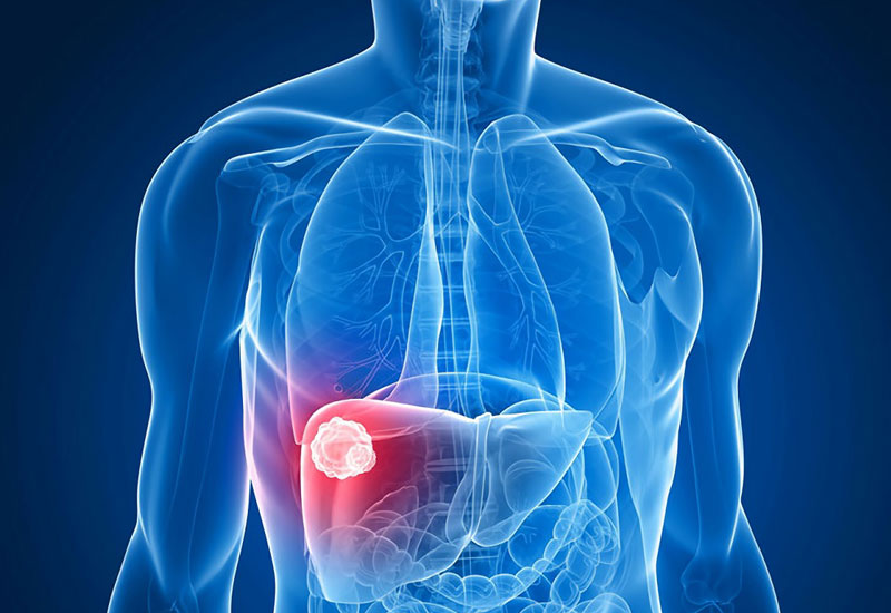 U gan lành tính là tình trạng xuất hiện các khối u trong gan, có bản chất không phải ung thư