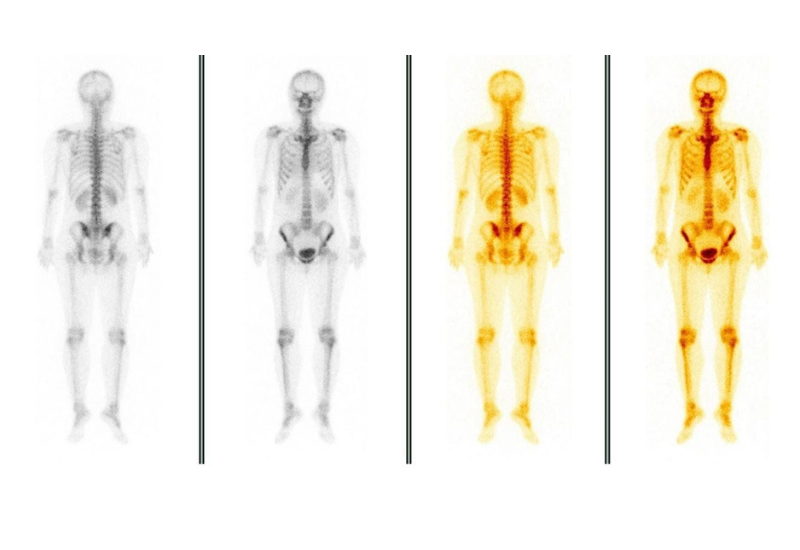 Kết quả quét và ghi hình xạ hình xương