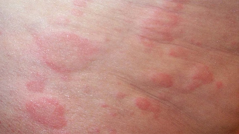 What are the possible causes of itchy and bumpy rashes (mẩn ngứa nổi cục) on the skin?