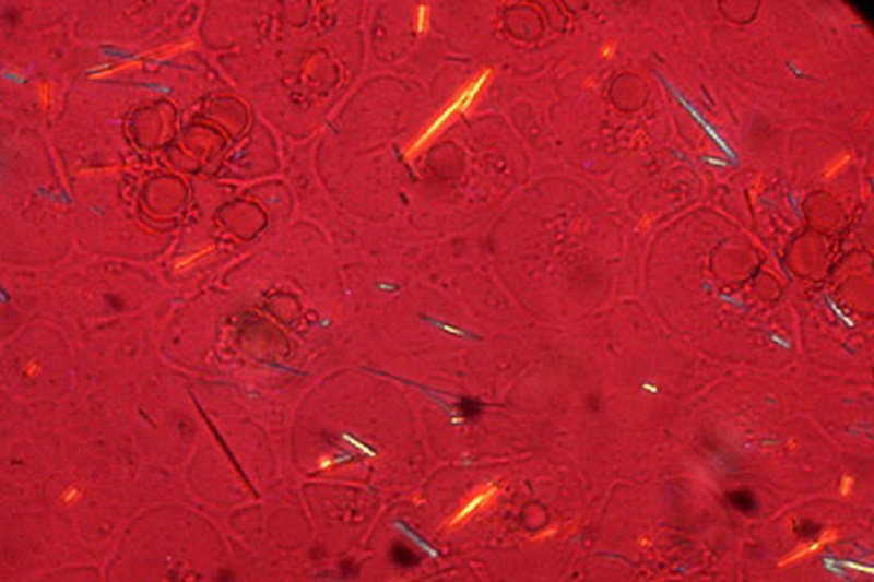 Tiêu chuẩn vàng chẩn đoán Gout: tìm thấy tinh thể urat trong dịch khớp dưới kính hiển vi phân cực (tinh thể hình kim, màu vàng)