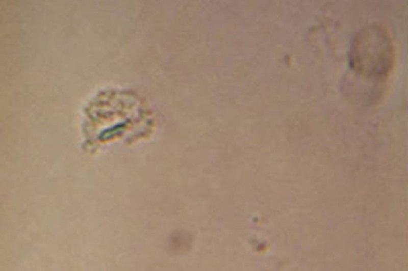 Hình ảnh tinh thể canxi pyrophosphate màu xanh trên kính hiển vi phân cực