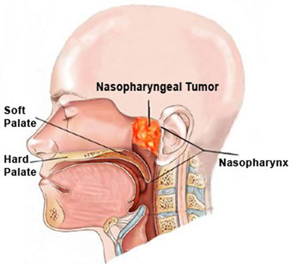 Hình ảnh khối u xơ vòm mũi họng (Juvenile nasopharyngeal angiofibroma – JNA)