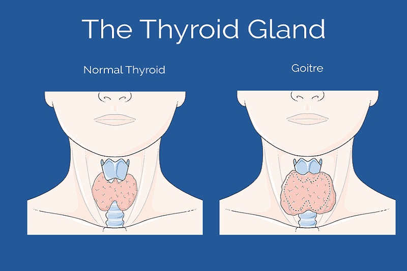Tuyến giáp bình thường và bướu giáp lan tỏa