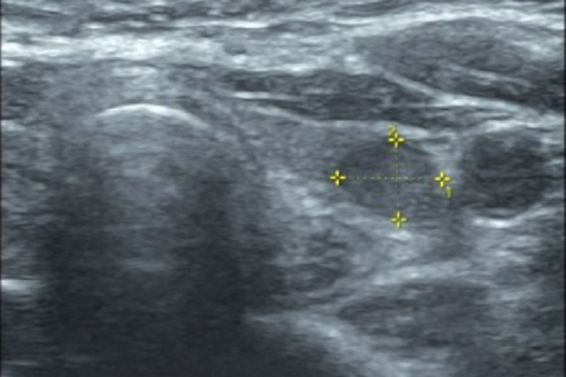 Hình ảnh bướu nhân tuyến giáp trên siêu âm