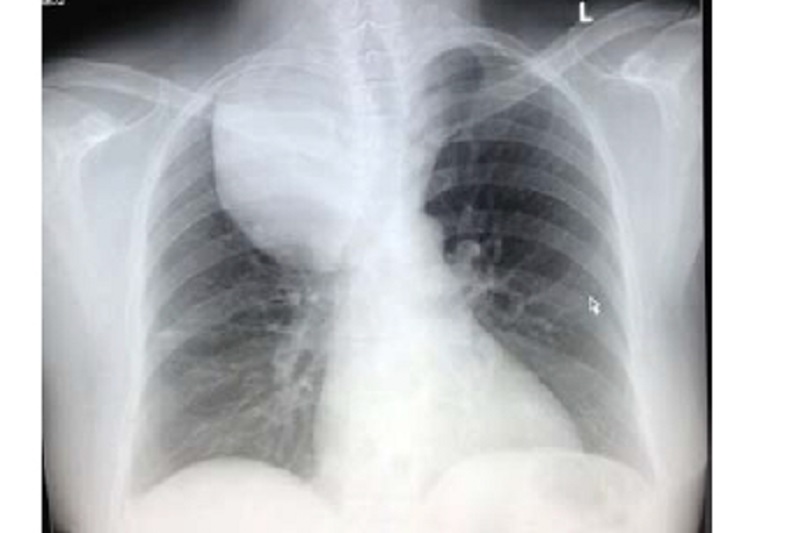 Hình ảnh bướu giáp trong lồng ngực trên phim x-quang