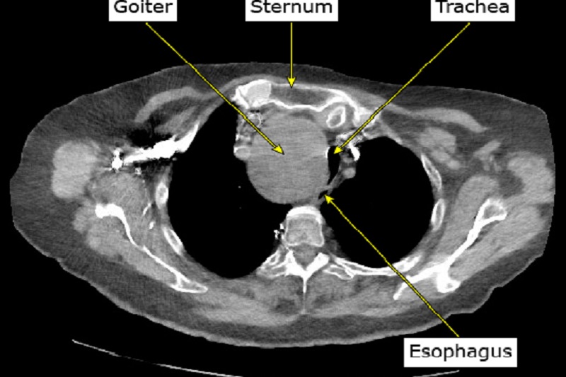 Hình ảnh bướu giáp trong lồng ngực chèn ép khí quản và thực quản