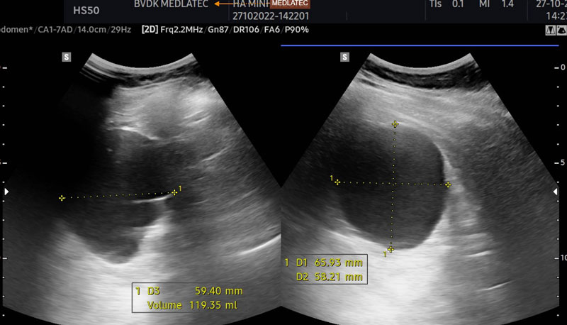 Hình ảnh nang thận khi siêu âm