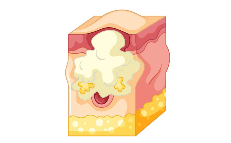 U bã đậu thường là u lành tính, có thể xuất hiện tại nhiều vị trí trên cơ thể