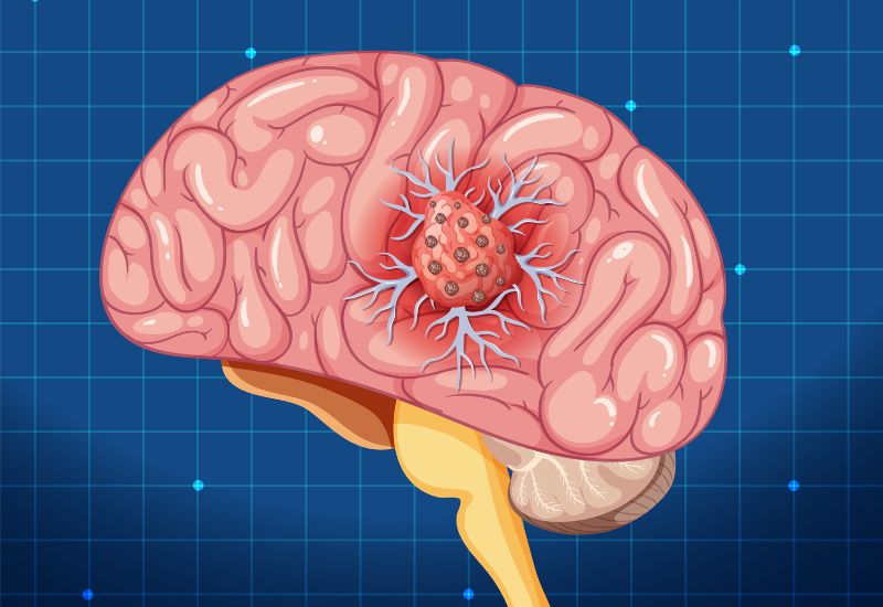 Đau đầu, buồn nôn kéo dài có thể là biểu hiện u não