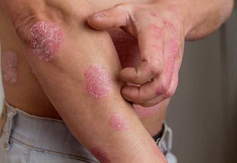 Tìm hiểu Bệnh chàm da là gì - Nguyên nhân, triệu chứng và cách điều trị bệnh chàm da