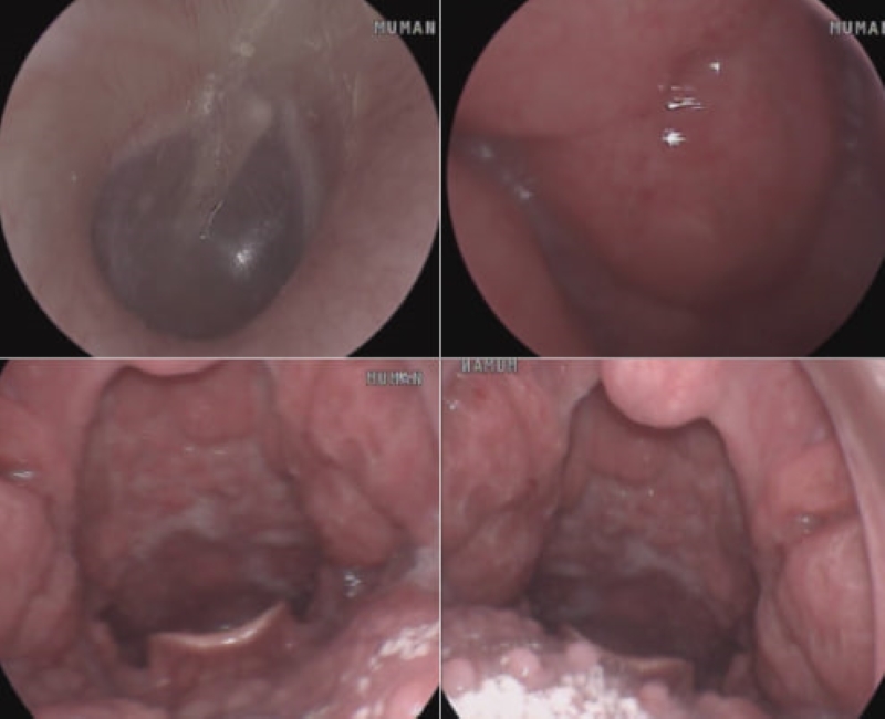 Kết quả nội soi tai mũi họng cho thấy hình ảnh viêm họng xung huyết