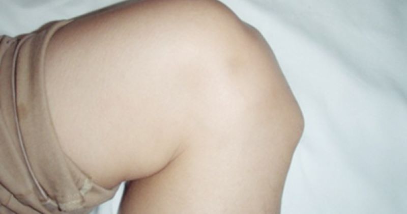 Các vấn đề liên quan đến khớp gối có thể là nguyên nhân khiến xương đầu gối nhô ra 