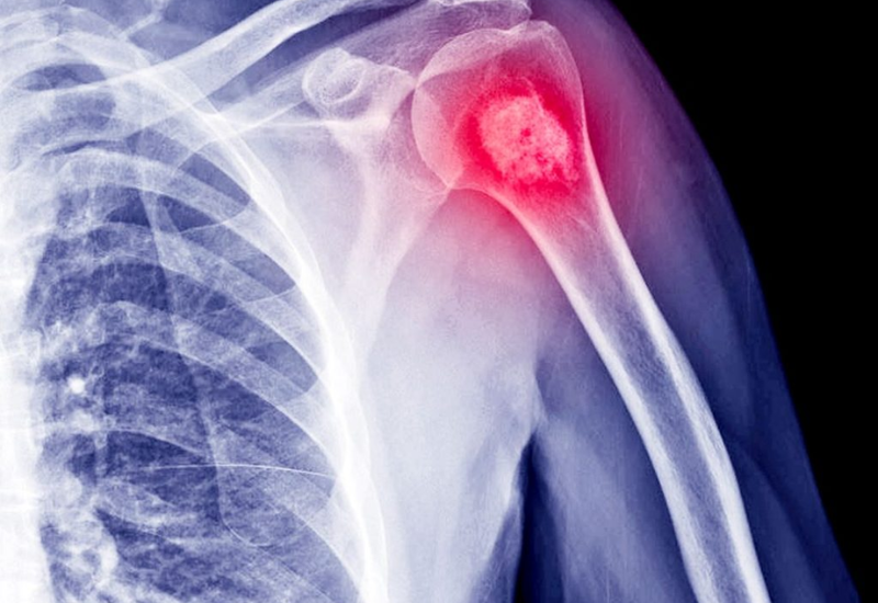 U xương là tình trạng trong cấu trúc xương xuất hiện khối u bất thường