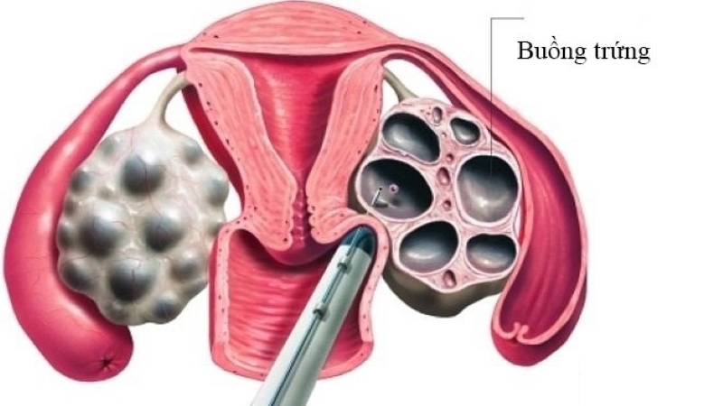 Chọc trứng là một bước can thiệp y học giữ vai trò then chốt trong các phương pháp hỗ trợ sinh sản