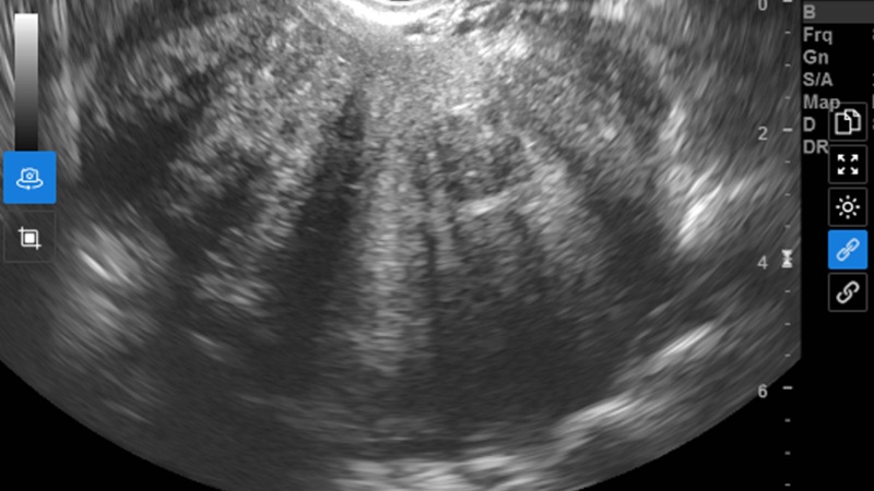 Kết quả siêu âm ghi nhận hình ảnh bất thường ở tử cung 