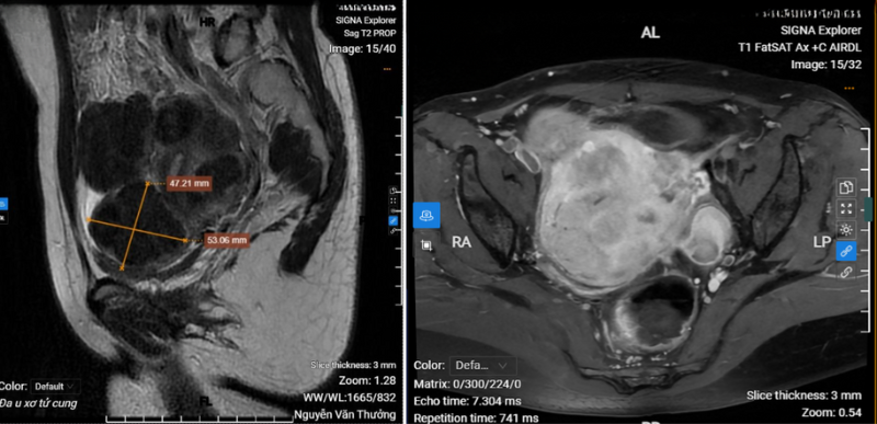 Chụp MRI vùng tiểu khung cho thấy hình ảnh đa u xơ tử cung 