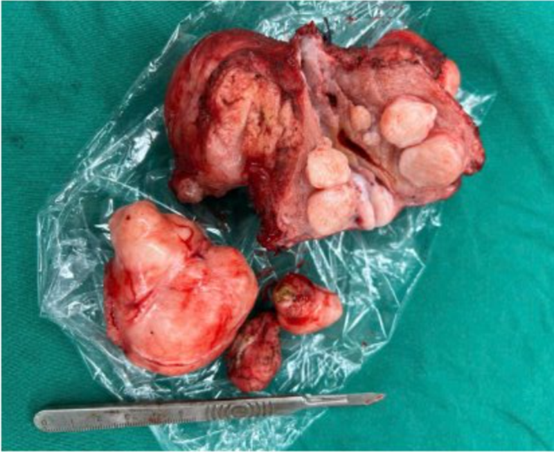 Hình ảnh khối u xơ tử cung sau khi được phẫu thuật cắt bỏ 