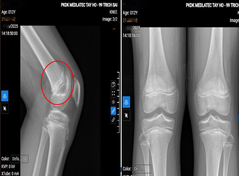 Hình ảnh chụp X-quang khớp gối trái của bệnh nhân 
