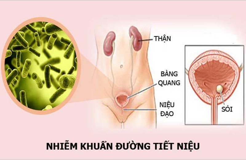 Vi khuẩn E.Coli là tác nhân phổ biến gây viêm bàng quang. Ảnh minh họa