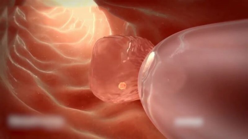 Chuyển phôi là quá trình đưa phôi thai vào đúng vị trí buồng tử cung