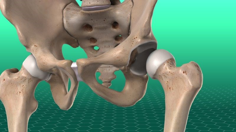 Trật khớp háng kiểu chậu xảy ra khi chỏm xương đùi bị bật ra khỏi ổ cối của xương chậu