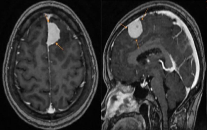 Hình ảnh khối u được phát hiện trên phim chụp MRI