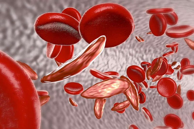 Triệu chứng của bệnh thiếu máu hồng cầu hình liềm là gì?

