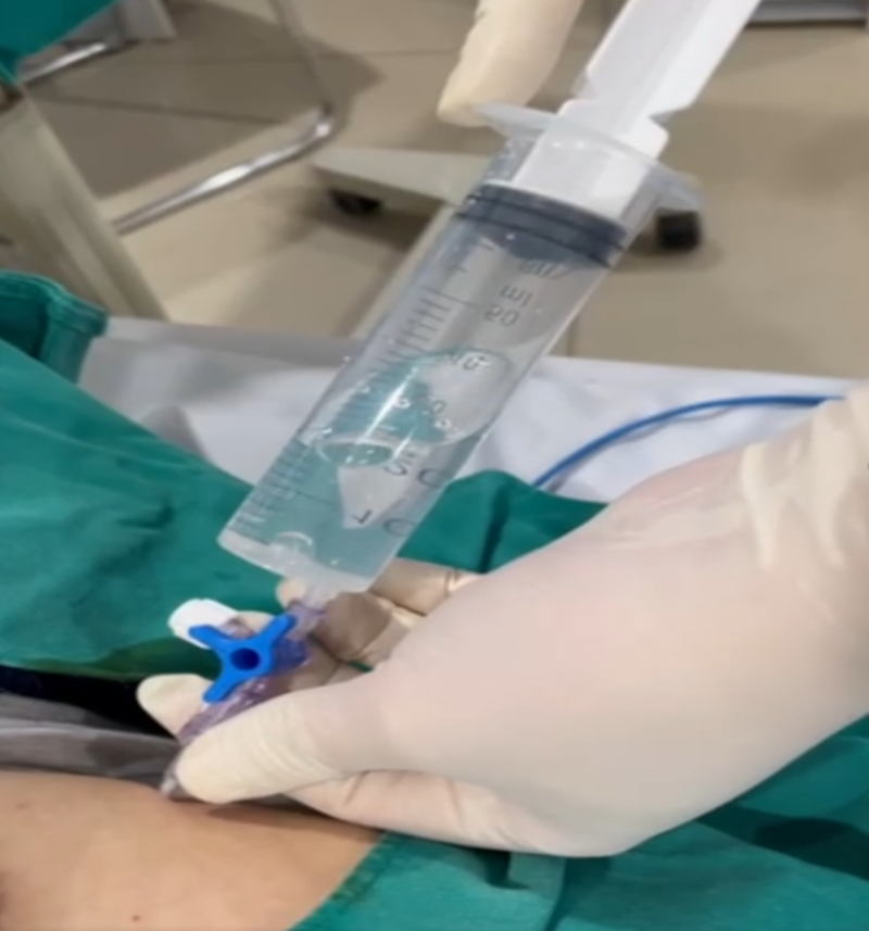 Hình ảnh bác sĩ chọc hút dẫn lưu khí màng phổi trái bằng kim lớn 14G tại khoang liên sườn 2-3 thẳng đường giữa xương đòn trái và KLS 4-5 đường nách trước  