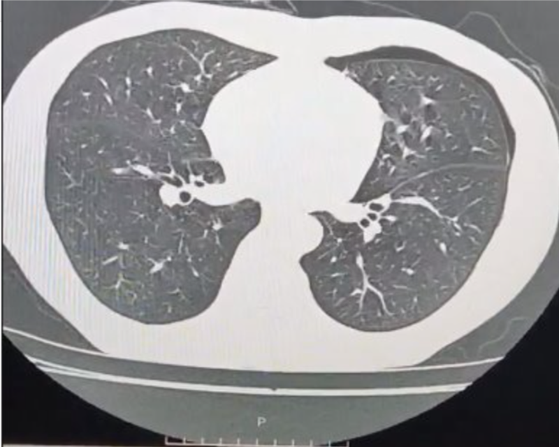 Hình ảnh phim chụp sau khi chọc hút khí màng phổi cho thấy lượng khí tràn ở phổi còn ít 