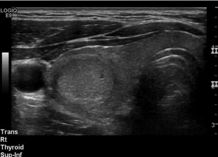 Hình ảnh siêu âm của u lành tuyến giáp