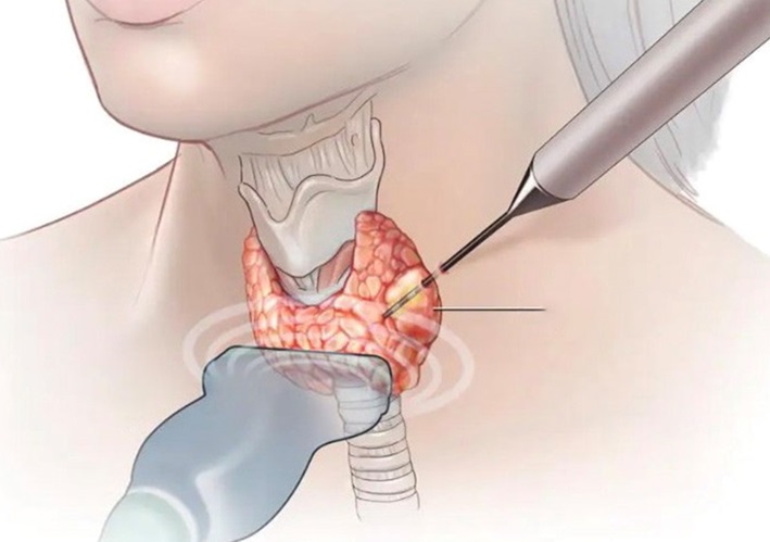 Kỹ thuật đốt sóng cao tần và chọc hút kim nhỏ
