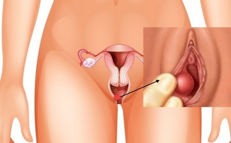 Nang Bartholin hình thành do ống dẫn tiết dịch của tuyến Bartholin bị tắc nghẽn